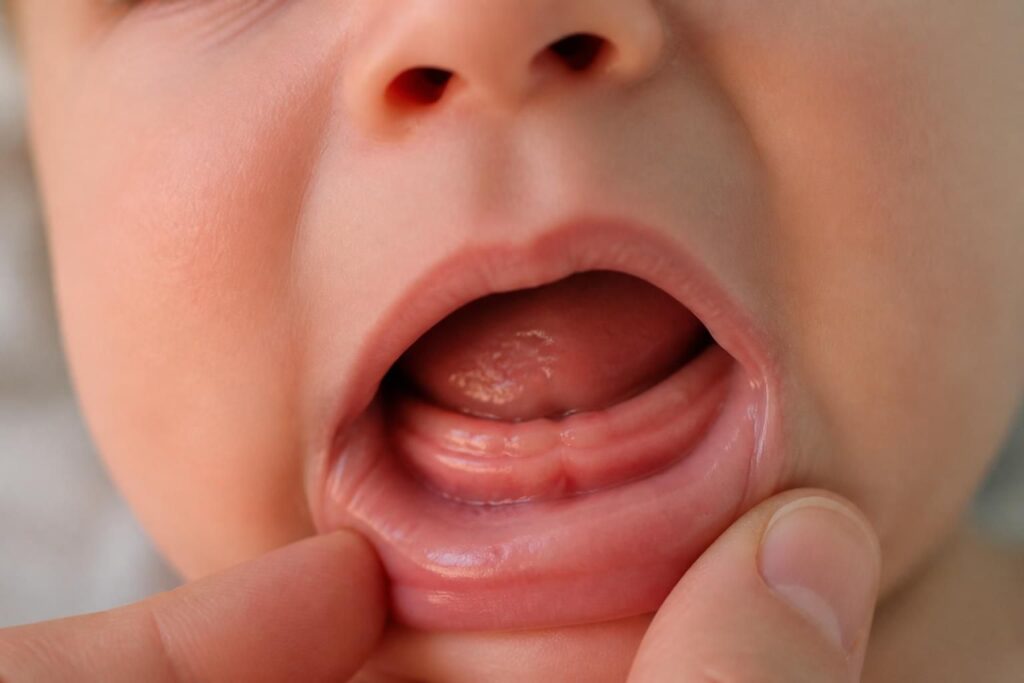 découvrez les signes du doublement des gencives chez le bébé et l'âge typique d'apparition pour mieux accompagner la poussée dentaire de votre enfant.